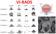 Новая информация по VI-RADS